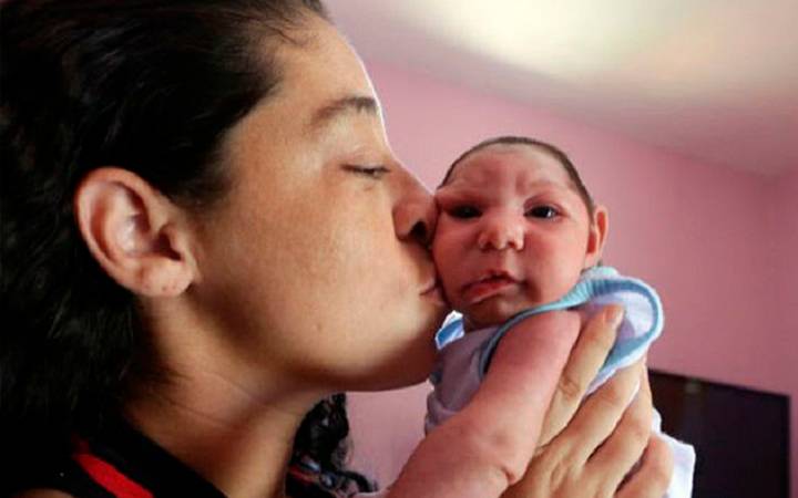 Crianças com microcefalia têm direito a pensão vitalícia